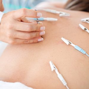 electroacupuncture treatment